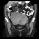Mixed adenoneuroendocrine tumour of appendix, mixed tumour, hydronephrosis, ascites: CT - Computed tomography